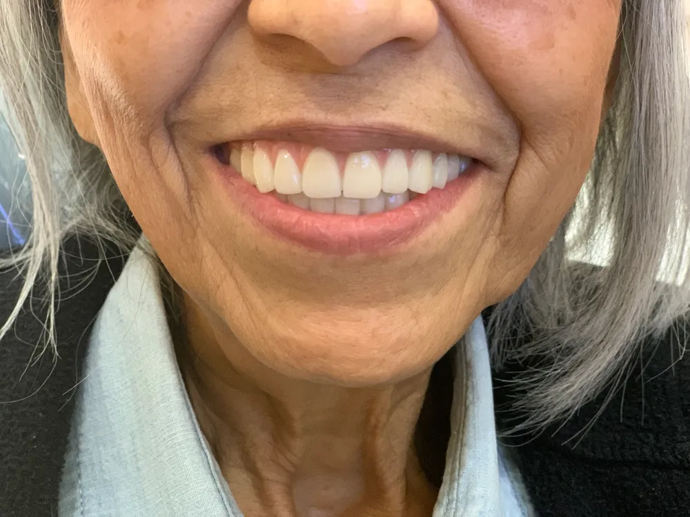 Close-up of a restored smile after dental treatment