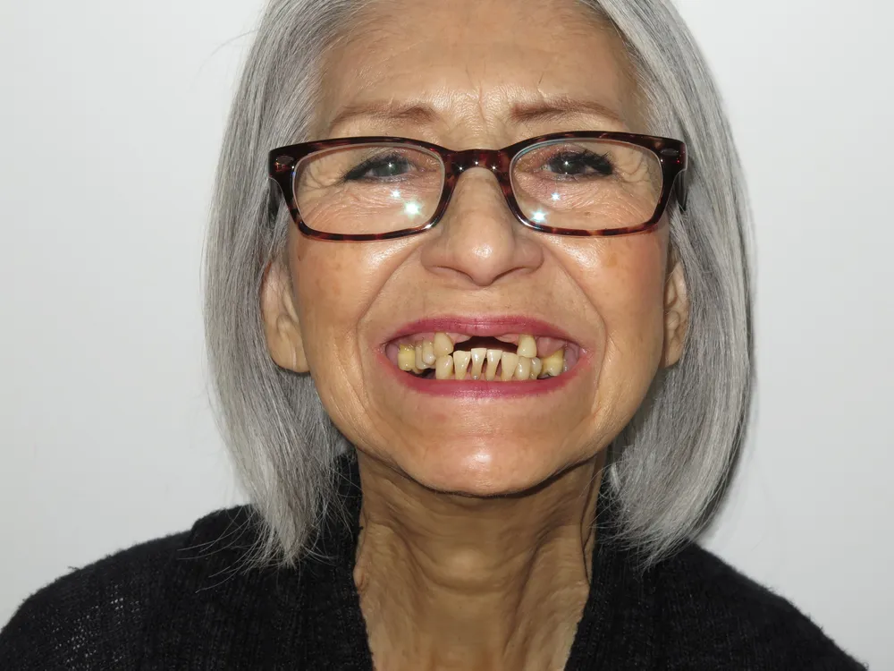 Patient before dental implant treatment